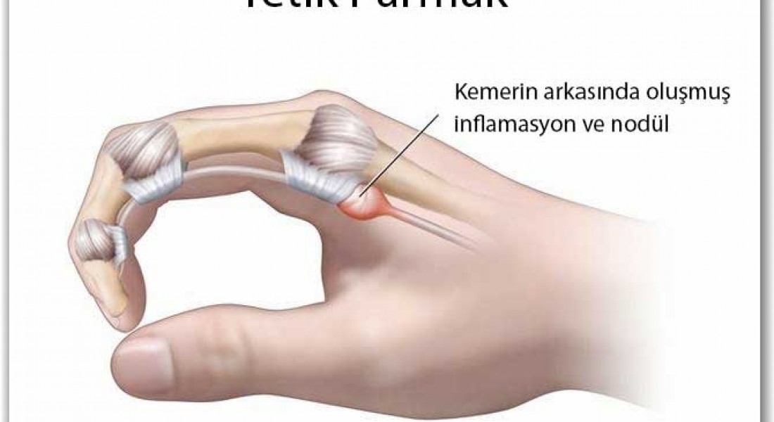Что такое «щелкающий палец»? Симптомы, причины и методы лечения