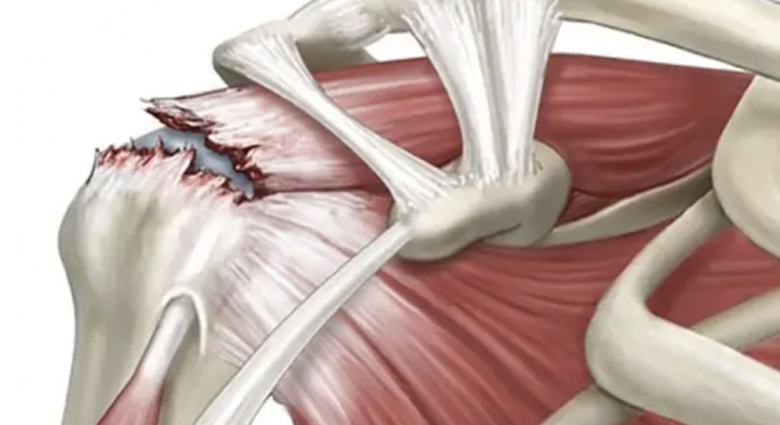 Что такое разрыв вращательной манжеты плеча?
