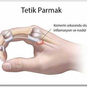 Что такое «щелкающий палец»? Симптомы, причины и методы лечения