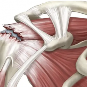 Что такое разрыв вращательной манжеты плеча?