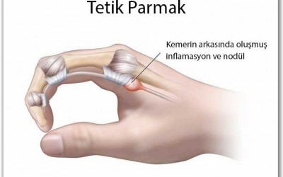 Что такое «щелкающий палец»? Симптомы, причины и методы лечения