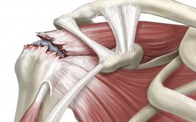 Что такое разрыв вращательной манжеты плеча?