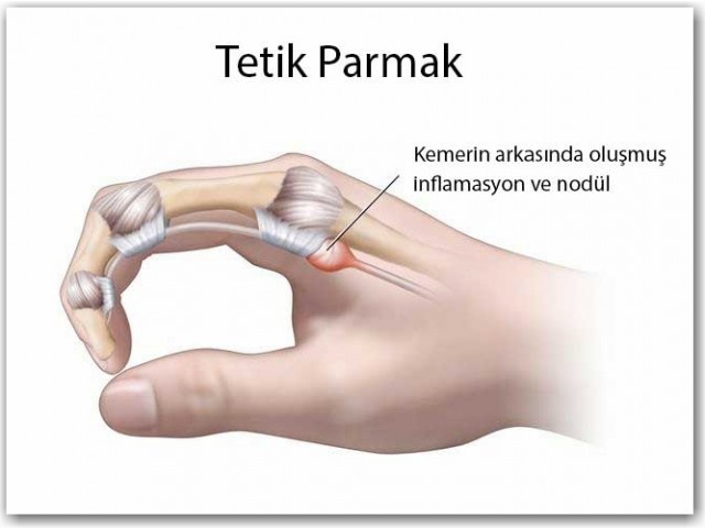 Что такое «щелкающий палец»? Симптомы, причины и методы лечения