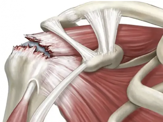 Что такое разрыв вращательной манжеты плеча?